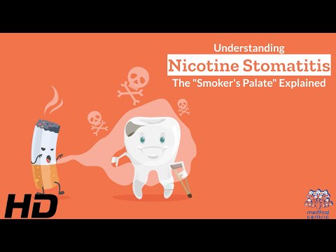 Hyperdontia Causes Signs and Symptoms Diagnosis and Treatment