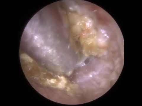 855 - Infected Keratosis Obturans Removal