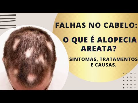 , title : 'O que é alopecia areata? sintomas causas e tratamento'