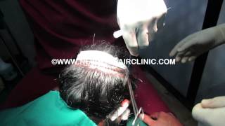 preview picture of video 'Hair Replacement Cost in India'