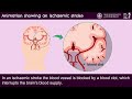Animation Showing An Ischaemic Stroke