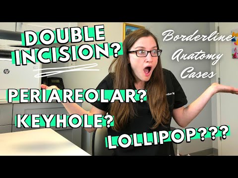 Top Surgery - Double Incision vs. Peri/Keyhole // Plastic Surgeon Explains Borderline Anatomy Cases