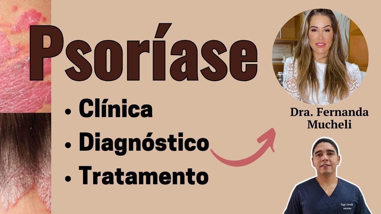 Psoríase diagnóstico e tratamento