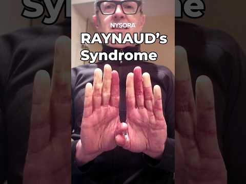 Epinephrine in Raynaud's Syndrome? #raynauds #syndrome #epinephrine #nysora #anesthesia