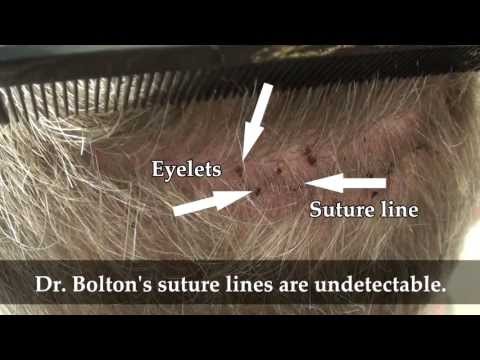 Patient 107 Undetectable Scar: 10 day