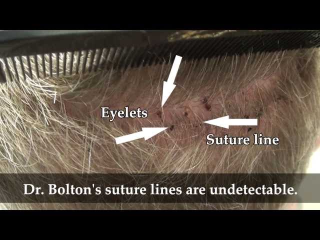 Patient 107 Undetectable Scar: 10 day
