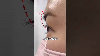 속눈썹 펌 성형 시술