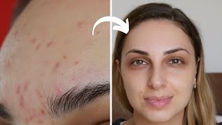 HYPERPIGMENTATION (Dark Spots) Treatment ✨ This is How to Remove The ACNE MARKS!