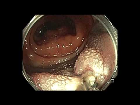 Colonoscopy: Rectosigmoid colon polyp resection