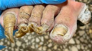 The Patient's Toenails Were Curled Like Flowers And Were Separated Step By Step【Xue Yidao】
