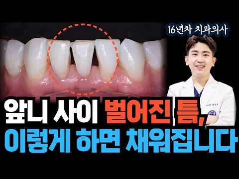 치아 사이 벌어진 틈, 요새는 이렇게 치료합니다