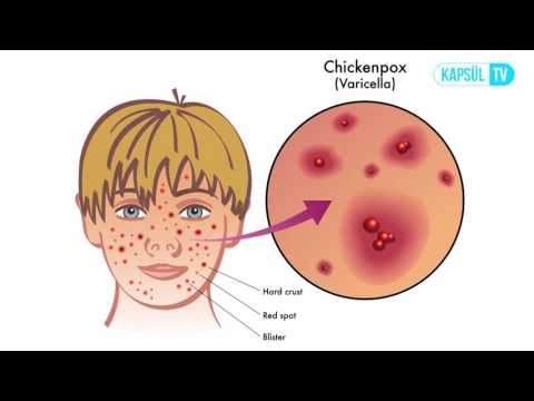 Su Çiçeğinin Belirtileri Nelerdir?