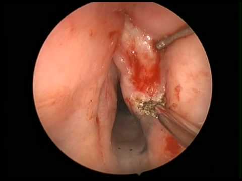 Vocal Cord Dysplasia Using the flexible Elevate ENT CO2 Laser