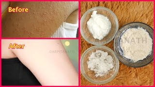 How to Get Rid of Tiny Red Bumps, Rashes from Face, Arms, Hips || Chicken Skin Treatment