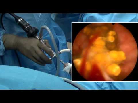 Cystoscopy: Coming out of Bladder and Urethra