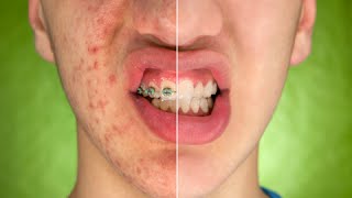 How to Stop Pimples Forever