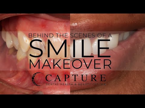 BEHIND THE SCENES OF A SMILE MAKEOVER @ CAPTURE DENTAL ARTS