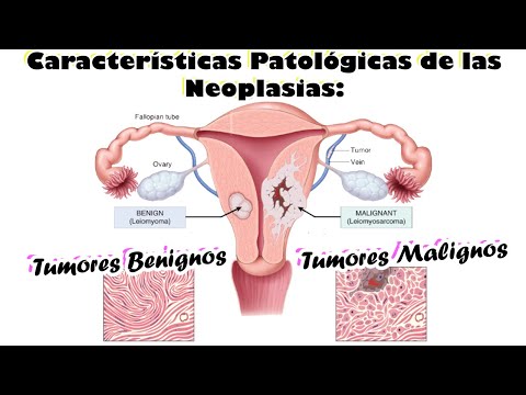 TUMOR BENIGNO vs TUMOR MALIGNO "Características Patológicas de las Neoplasias Benignas y Malignas"