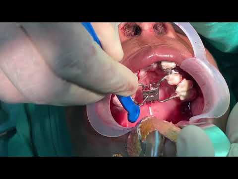 Anterior Maxillary Distraction - Osteotomy cuts completeness checked
