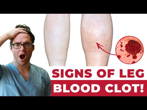 Blood Clot in the Leg? [ Early signs, Symptoms, How to Check & Causes]