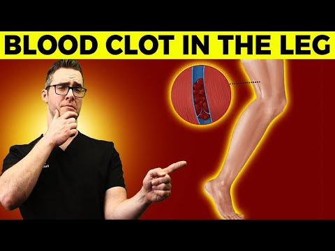 Blood Clot in leg symptoms What causes blood clots WHAT TO DO