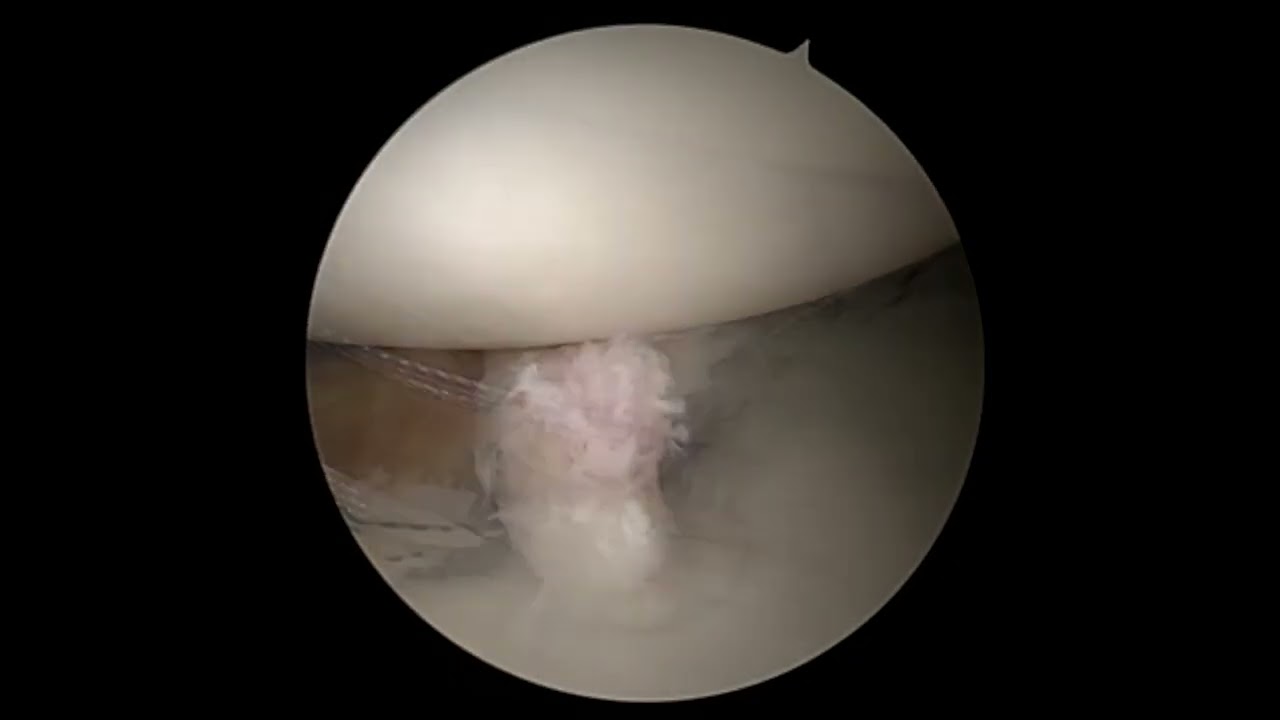 Updated Glenoid fracture repair with Remplissage in High Level Quarterback