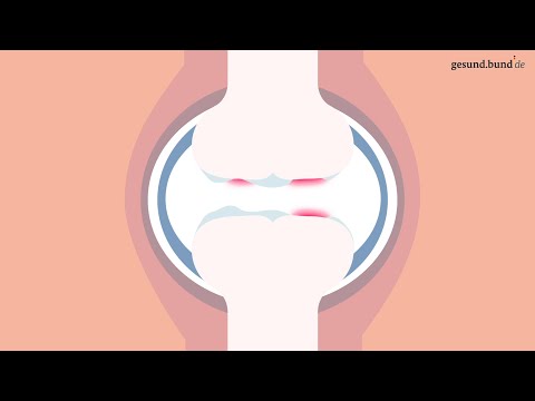 Wie entsteht eine Arthrose?