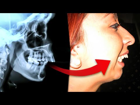 Excessive OVERBITE Correction without Surgery....SAFE Orthodontic Options