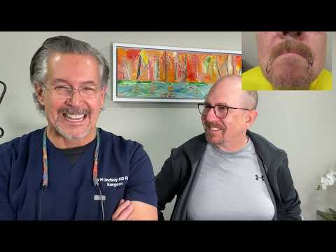 Hair transplant mustache and beard, 6 month results with interview, Dr Lindsey | McLean | VA | DC thumbnail