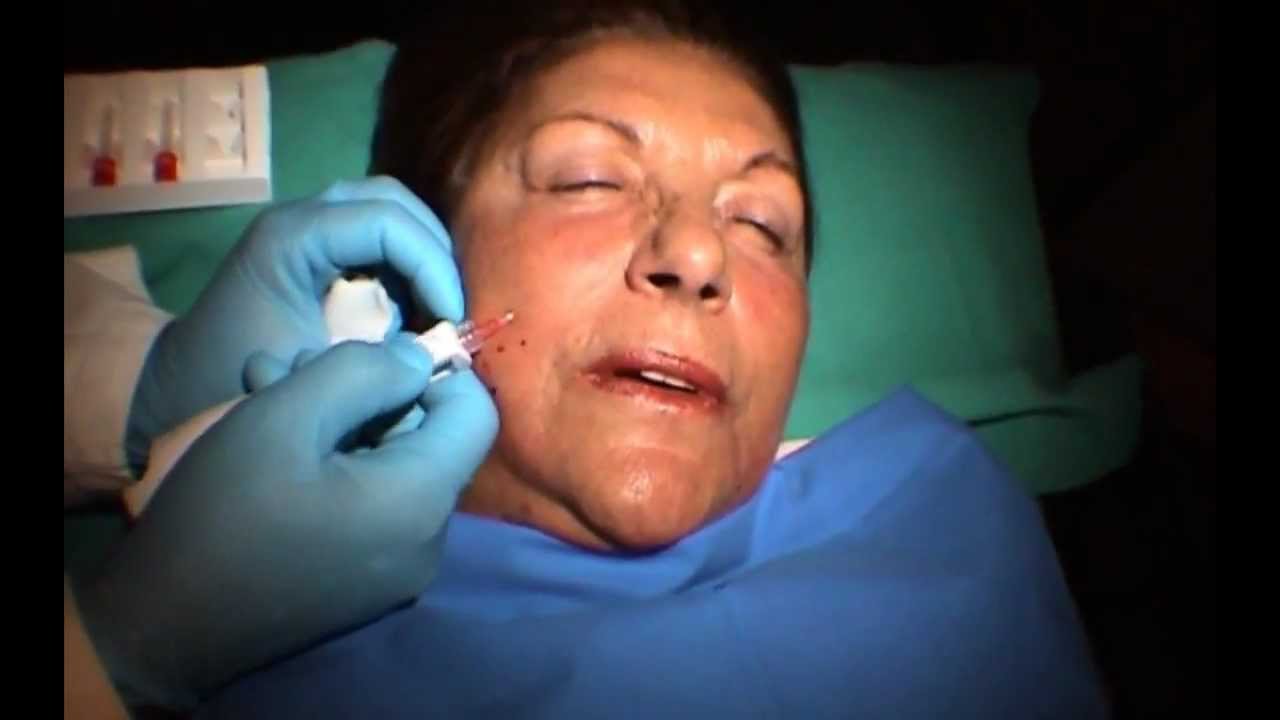 Biorivitalizzazione del volto con Restylane Vital Pen Injector