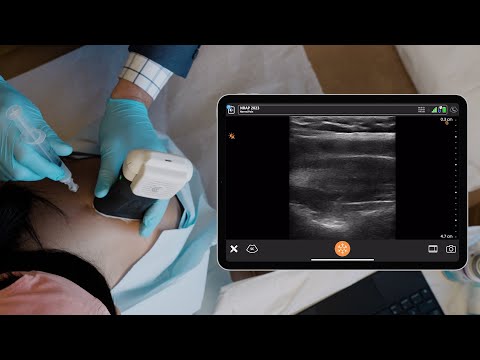 Suprascapular Nerve Block