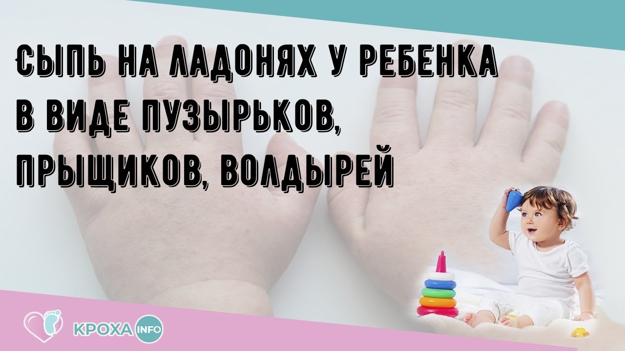 Сыпь на ладонях у ребенка в виде пузырьков, прыщиков, волдырей