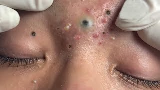 ystic Acne Extraction This Week, Blackheads Removal, Blackhead Extraction #