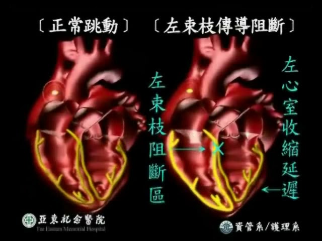 心臟衰竭合併左束枝傳導阻斷