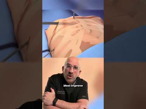 Sunken Chest Surgical Repair #shorts #pectus