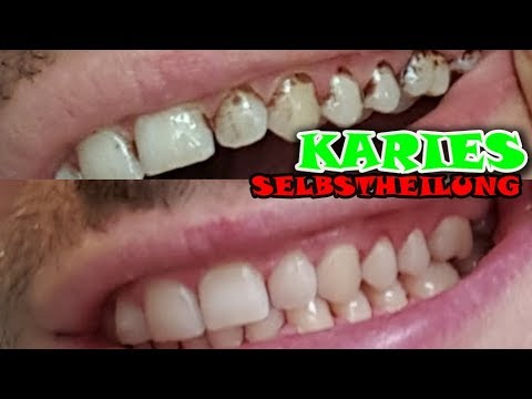 Neue Erkenntnisse über Karies und die Heilung - Karies selber heilen