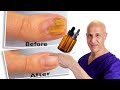 1 Oil Cures Toe Nail Fungus | Dr. Mandell