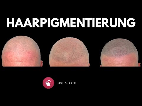 Behandlung einer Mikrohaarpigmentierung