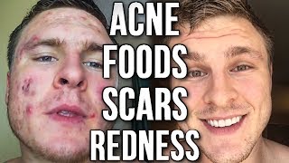 (LIVE) ACNE Q&A | Redness, Scars, Low-Dose Accutane, Dating & More!