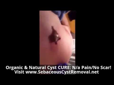 Home Cyst Removal | Home Remedies For Sebaceous Cyst