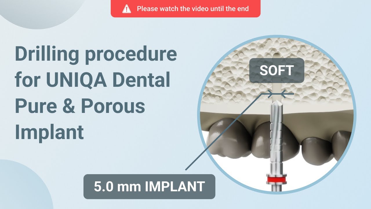 Drilling procedure for UNIQA Dental Pure & Porous Implant UH8 UV11 [ 5.0 mm | D4 bone density ]