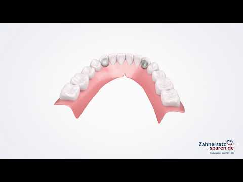 Behandlungsablauf: Coverdenture - Zahnersatzsparen.de