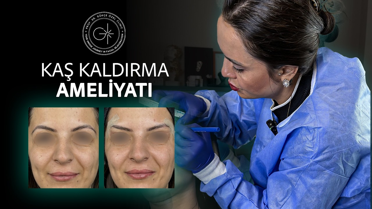Direkt Kaş Kaldırma Ameliyatı:Lokal Anestezi Altında Anında Sonuç