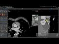Vitrea Applications Demonstrations CT Cardiac Analysis