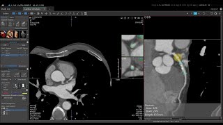 Vitrea Applications Demonstrations | CT Cardiac Analysis