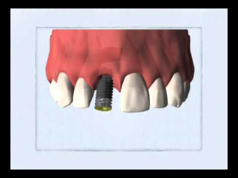 Praxis Dr. Erhard - Einzelzahn-Austausch