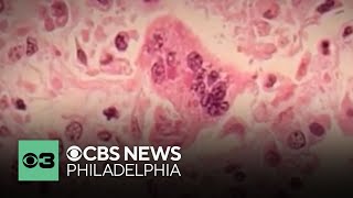 2 measles deaths reported in Lancaster County