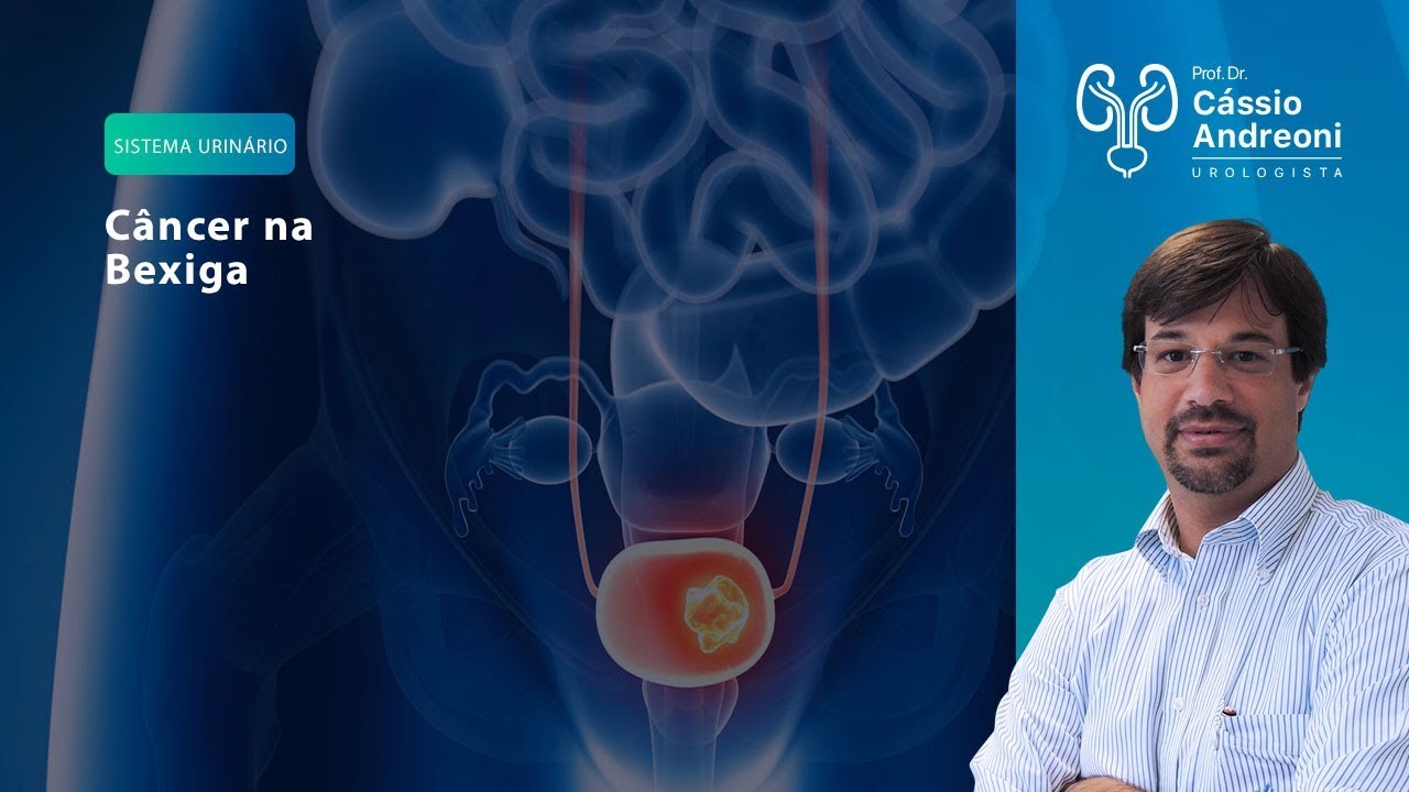 Câncer de Bexiga: causa, sintoma e tratamento | Dr. Cassio Andreoni CRM 78.546