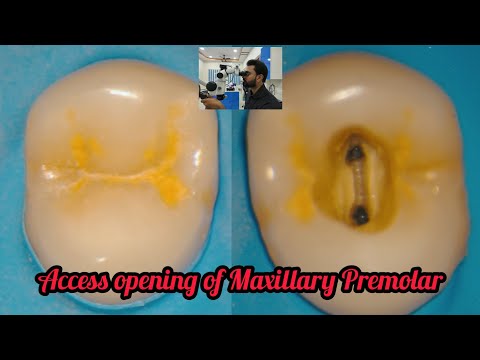 Access opening of Maxillary Premolar# step by step root canal demonstration#rct for beginners