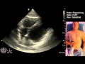 FAST Scan (Focused Assessment with Sonography in Trauma) - STEP by STEP